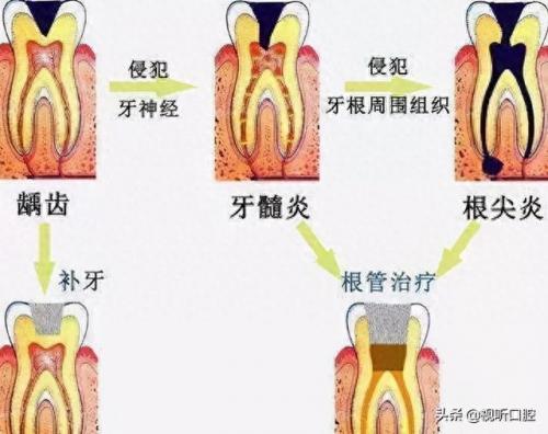 排名前十的牙疼(治牙疼最快的土方法)插图4