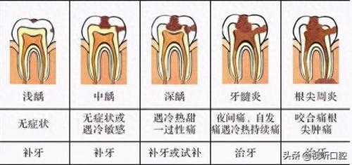 排名前十的牙疼(治牙疼最快的土方法)插图2