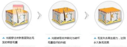 面部永久脱毛方法(家庭最简单的永久脱毛)插图9