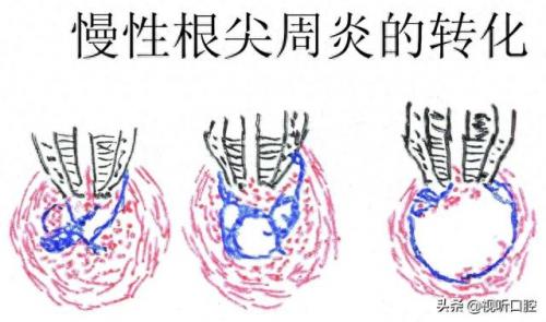 排名前十的牙疼(治牙疼最快的土方法)插图5
