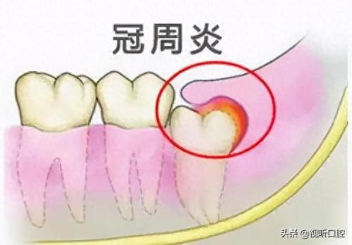 排名前十的牙疼(治牙疼最快的土方法)插图6