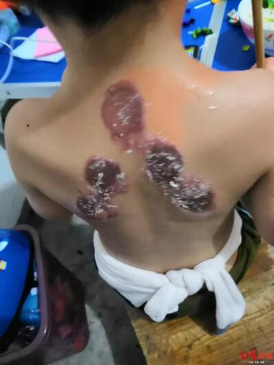 儿童贴三伏贴的危害(三伏贴是不是智商税)插图