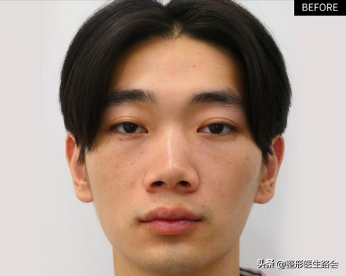 男士隆鼻(杭州连天美容整形医院)插图1