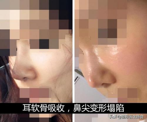 男士隆鼻(杭州连天美容整形医院)插图3