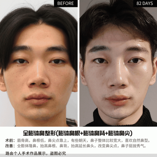 男士隆鼻(杭州连天美容整形医院)插图6