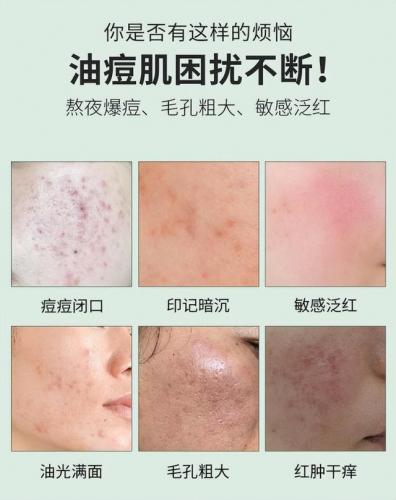 去痘痘产品(祛痘药膏排行榜10强)插图3