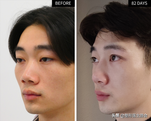 男士隆鼻(杭州连天美容整形医院)插图8