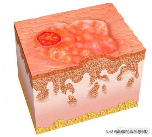 皮肤癌症状(皮肤癌是良性还是恶性)插图1