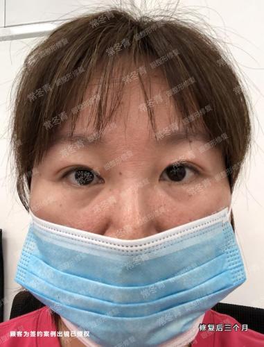 天津双眼皮修复大夫排行榜(修复双眼皮的十大专家)插图5