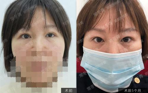 天津双眼皮修复大夫排行榜(修复双眼皮的十大专家)插图7