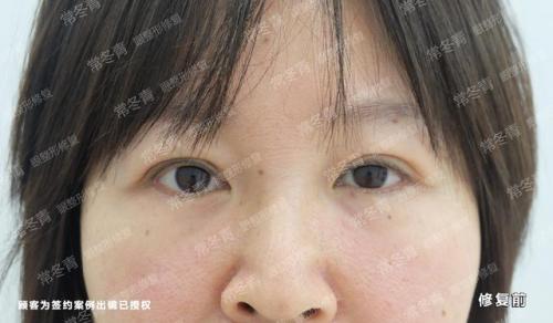 天津双眼皮修复大夫排行榜(修复双眼皮的十大专家)插图