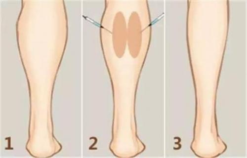 瘦腿药排行榜(国家正规的瘦腿产品)插图2