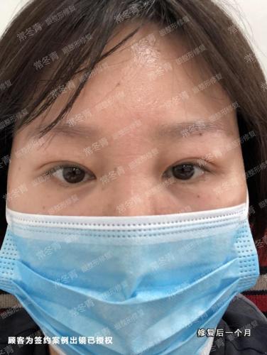 天津双眼皮修复大夫排行榜(修复双眼皮的十大专家)插图3
