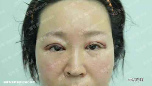天津双眼皮修复大夫排行榜(修复双眼皮的十大专家)插图2