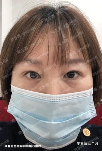 天津双眼皮修复大夫排行榜(修复双眼皮的十大专家)插图6